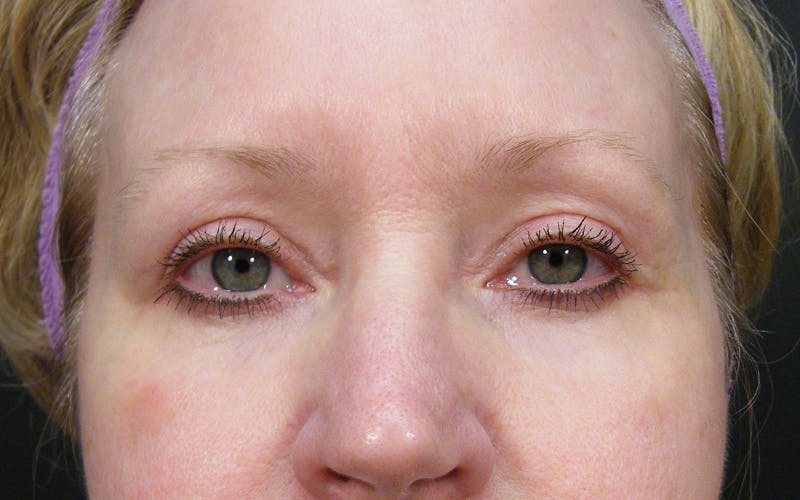 Cosmetic Surgeries Before & After Gallery - Patient 727574 - Image 2