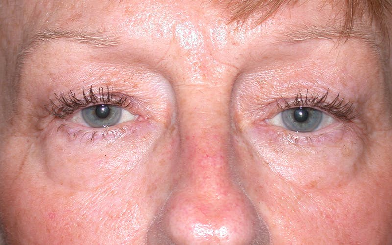 Cosmetic Surgeries Before & After Gallery - Patient 284921 - Image 1