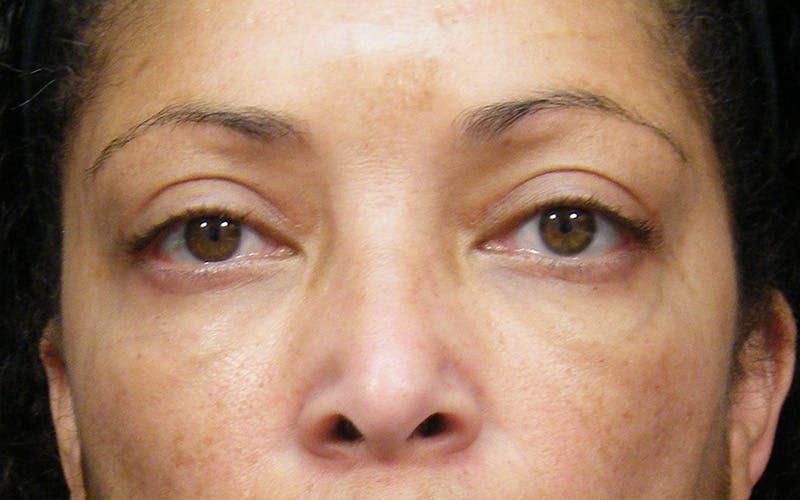 Cosmetic Surgeries Before & After Gallery - Patient 106609 - Image 2
