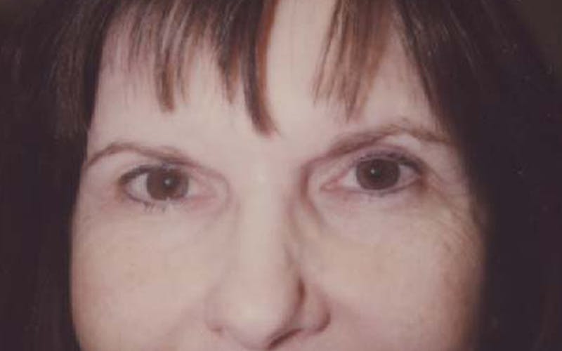 Cosmetic Surgeries Before & After Gallery - Patient 130722 - Image 1