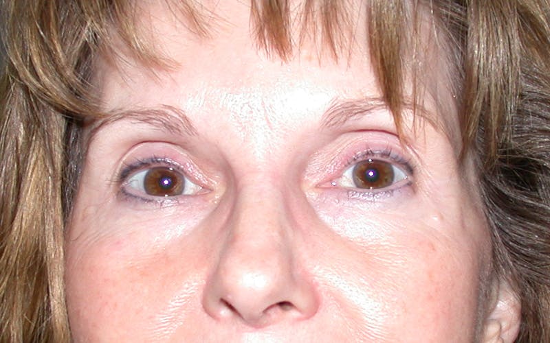Cosmetic Surgeries Before & After Gallery - Patient 130722 - Image 2