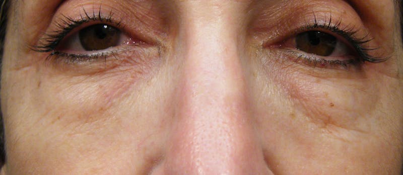 Cosmetic Surgeries Before & After Gallery - Patient 153113 - Image 1