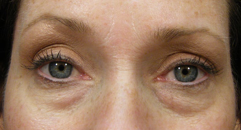 Cosmetic Surgeries Before & After Gallery - Patient 807817 - Image 1