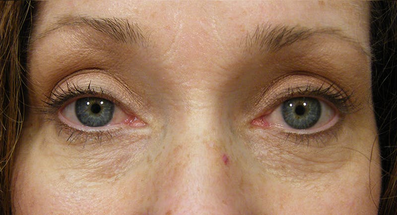 Cosmetic Surgeries Before & After Gallery - Patient 807817 - Image 2
