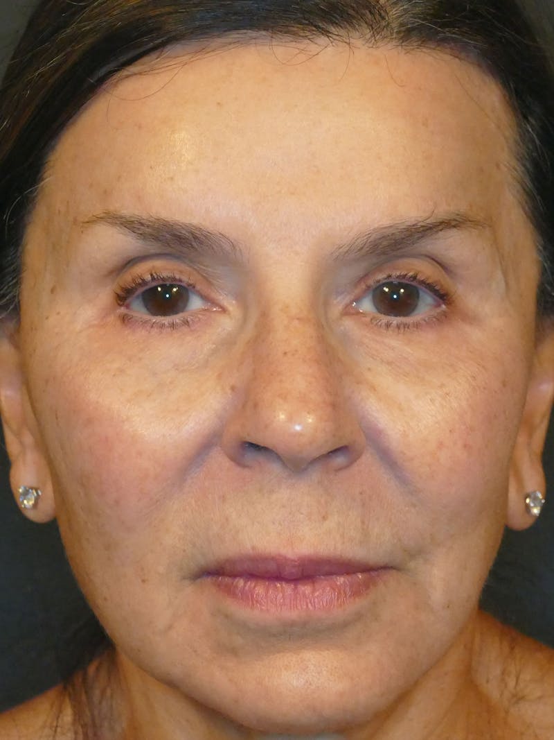 Total Rejuvenation Before & After Gallery - Patient 140797 - Image 2