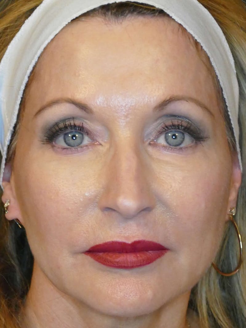 Total Rejuvenation Before & After Gallery - Patient 389114 - Image 2
