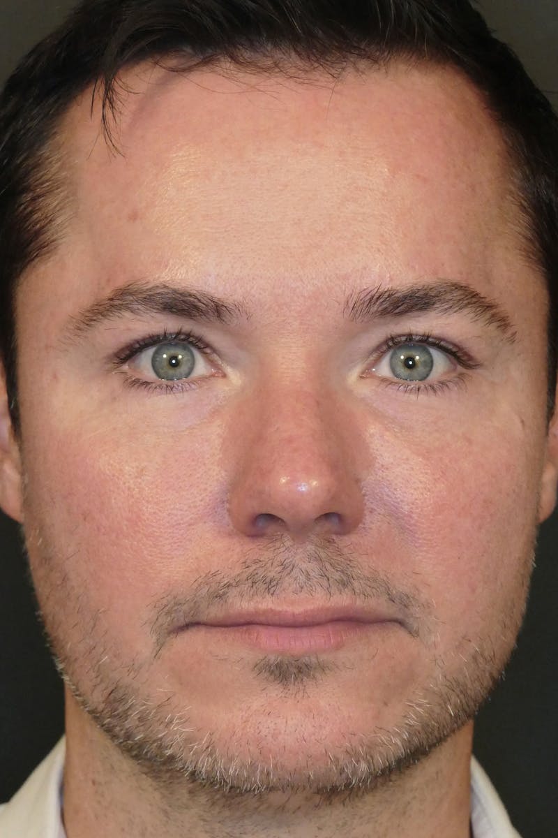 Total Rejuvenation Before & After Gallery - Patient 336235 - Image 2