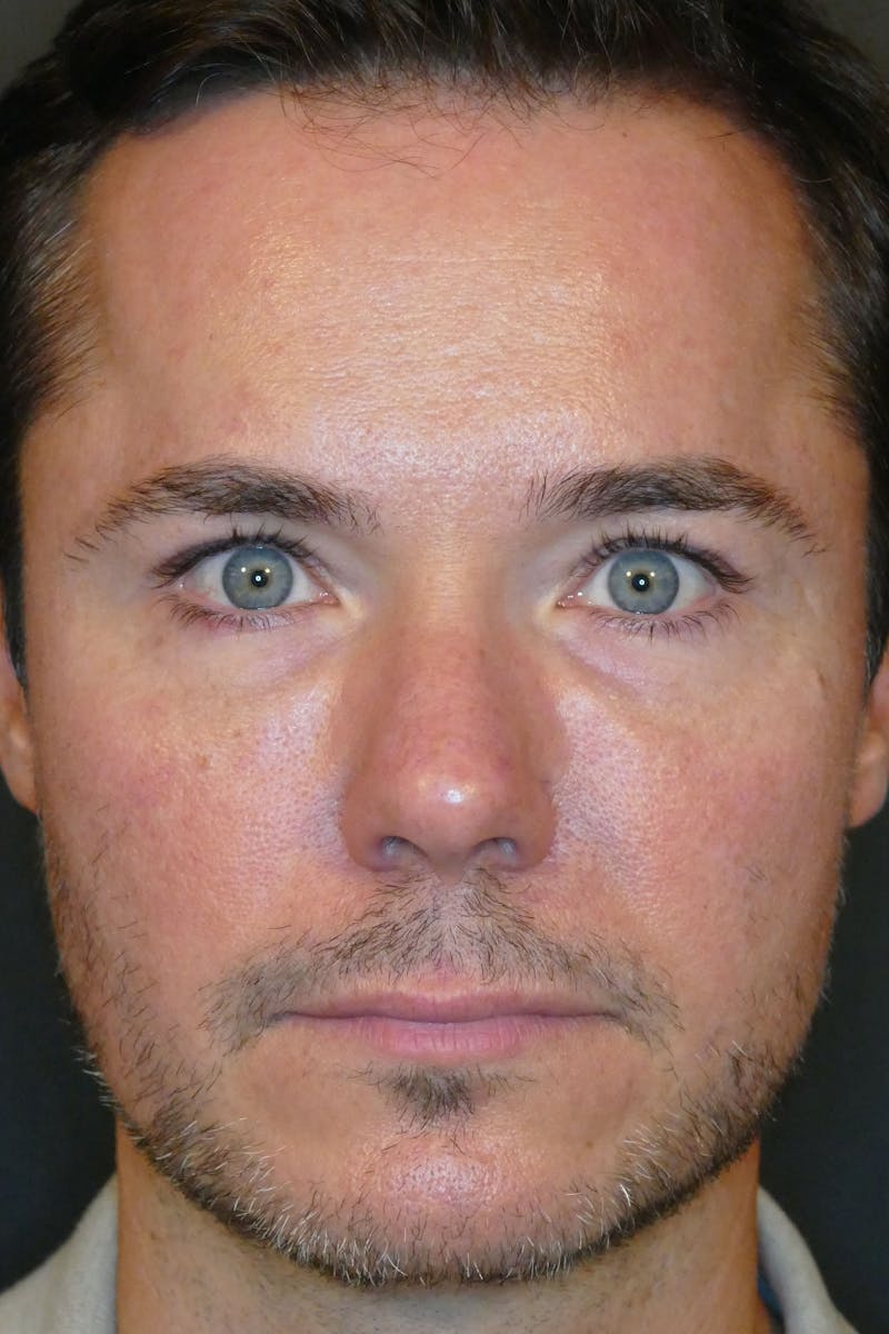Total Rejuvenation Before & After Gallery - Patient 336235 - Image 1