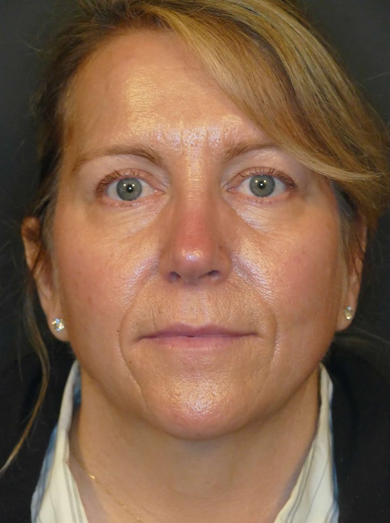 Total Rejuvenation Before & After Gallery - Patient 330921 - Image 1