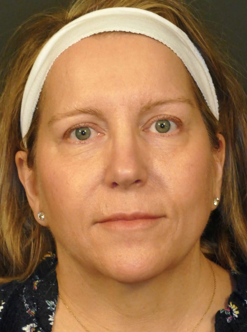 Total Rejuvenation Before & After Gallery - Patient 330921 - Image 2