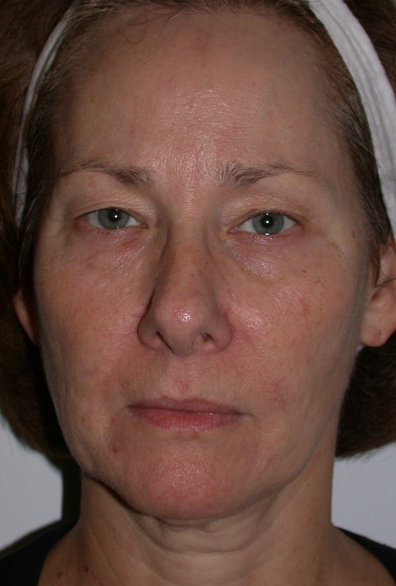 Thermage Before & After Gallery - Patient 160400 - Image 1