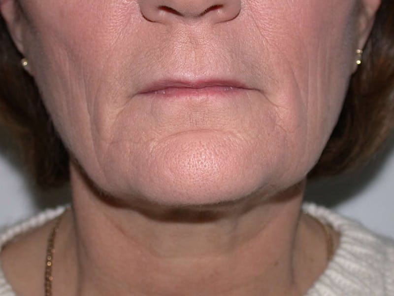 Thermage Before & After Gallery - Patient 246763 - Image 2
