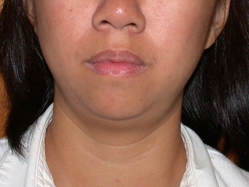 Thermage Before & After Gallery - Patient 228823 - Image 1