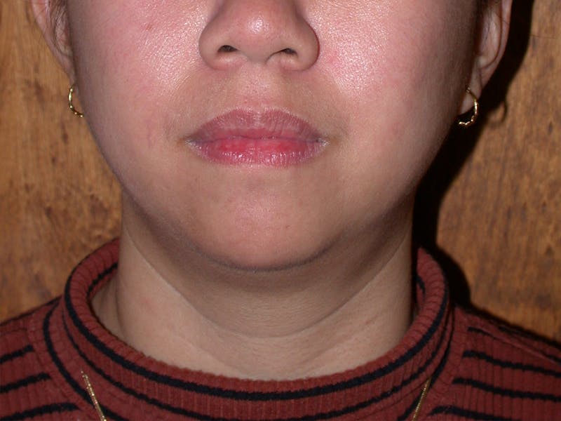 Thermage Before & After Gallery - Patient 228823 - Image 2
