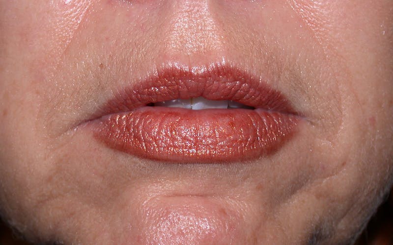 Liquid Facelift & Botunlinum Before & After Gallery - Patient 151571 - Image 3