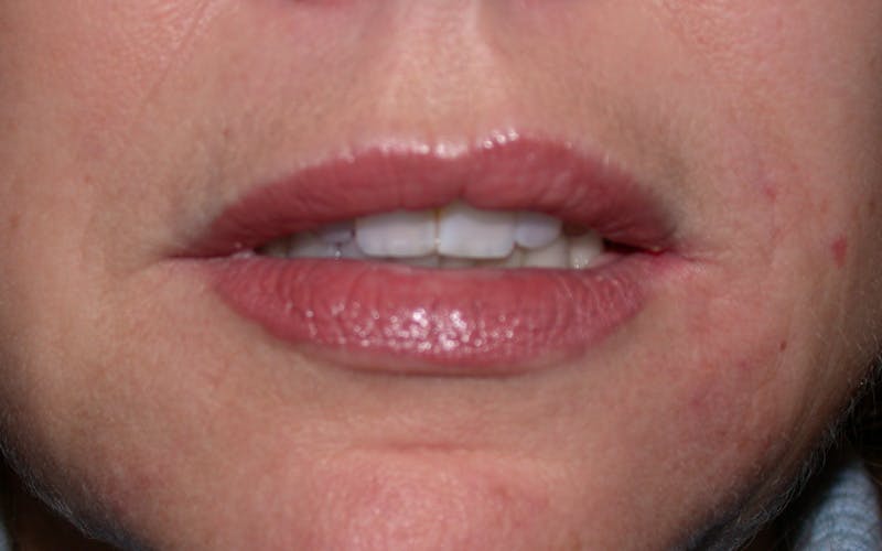 Liquid Facelift & Botunlinum Before & After Gallery - Patient 151571 - Image 4