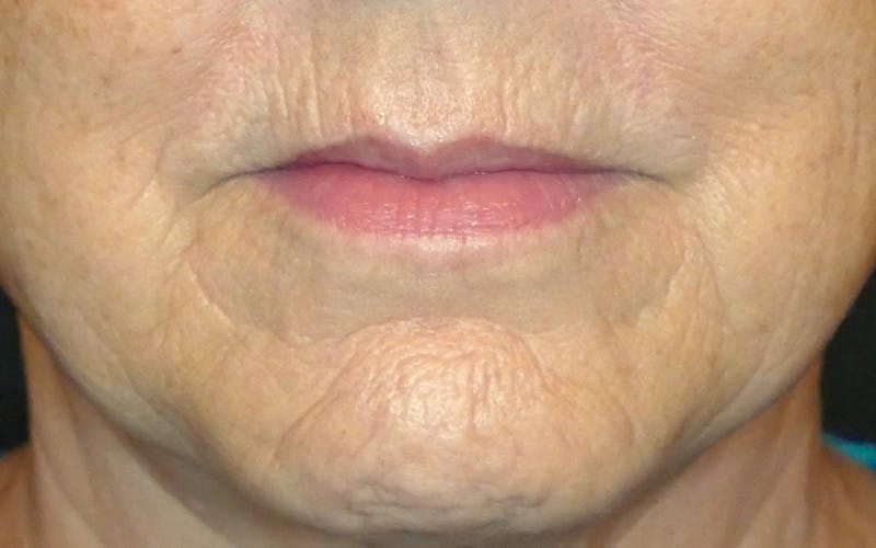 Liquid Facelift & Botunlinum Before & After Gallery - Patient 284569 - Image 1