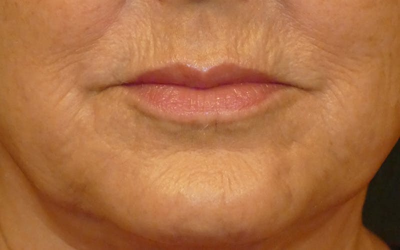Liquid Facelift & Botunlinum Before & After Gallery - Patient 284569 - Image 2