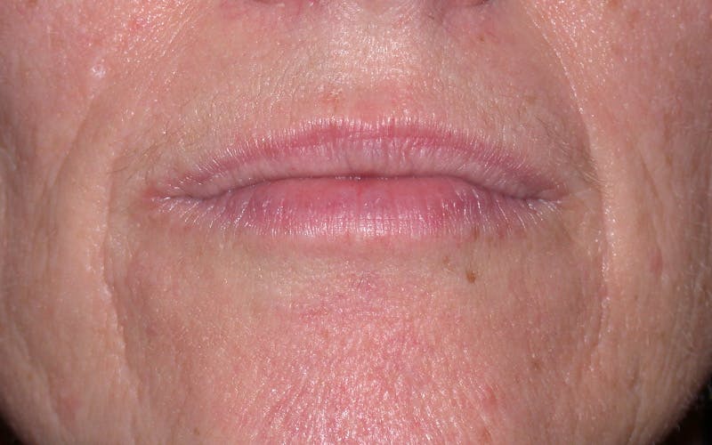 Liquid Facelift & Botunlinum Before & After Gallery - Patient 185270 - Image 1