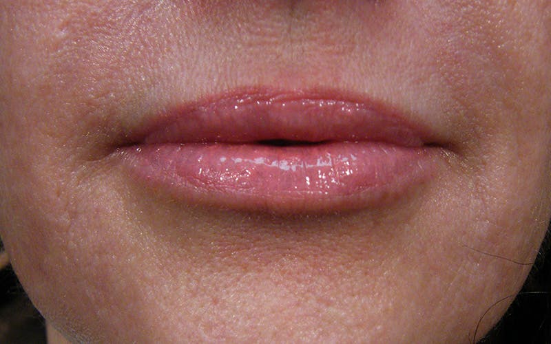 Liquid Facelift & Botunlinum Before & After Gallery - Patient 185270 - Image 2