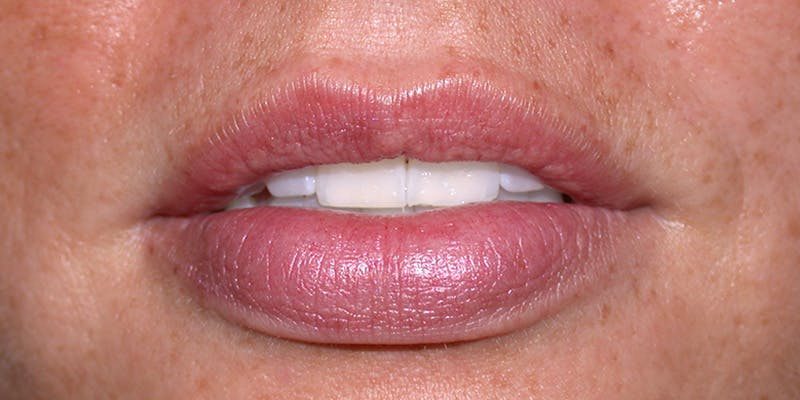 Liquid Facelift & Botunlinum Before & After Gallery - Patient 294616 - Image 2