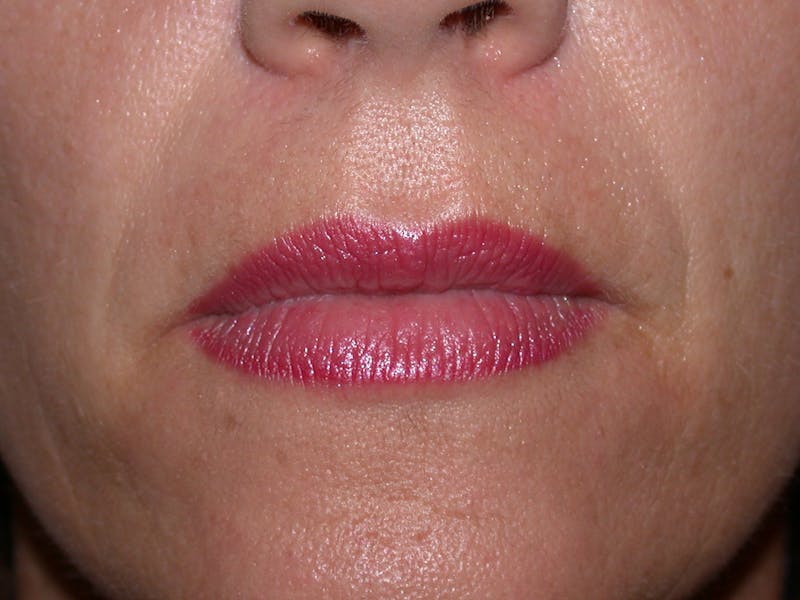 Liquid Facelift & Botunlinum Before & After Gallery - Patient 141003 - Image 3