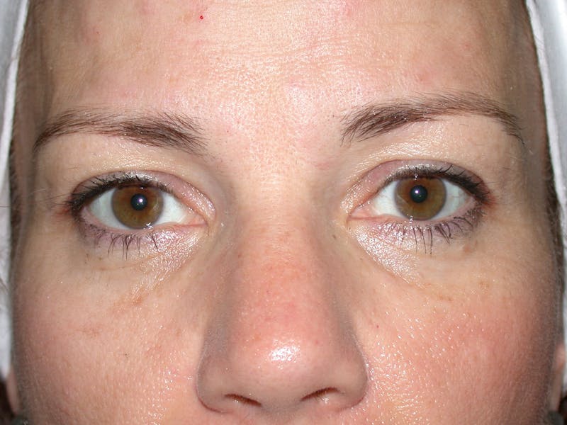 Liquid Facelift & Botunlinum Before & After Gallery - Patient 141003 - Image 1