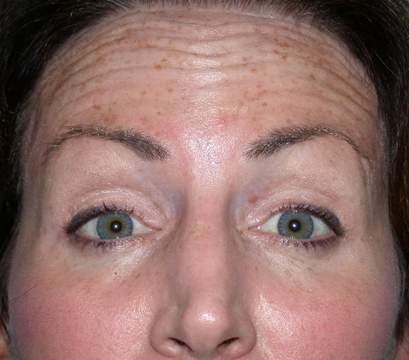 Liquid Facelift & Botunlinum Before & After Gallery - Patient 413422 - Image 1
