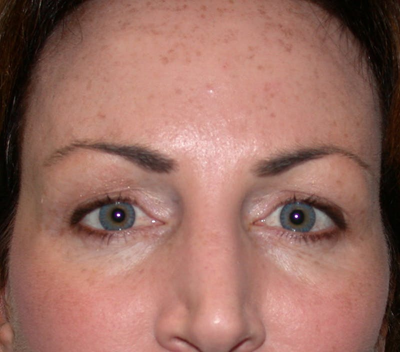 Liquid Facelift & Botunlinum Before & After Gallery - Patient 413422 - Image 2