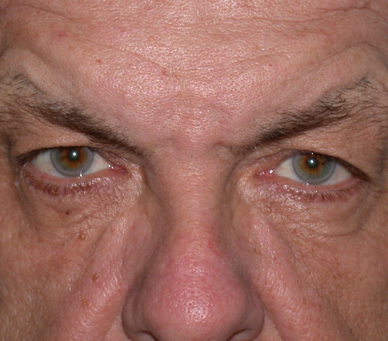 Liquid Facelift & Botunlinum Before & After Gallery - Patient 930884 - Image 1