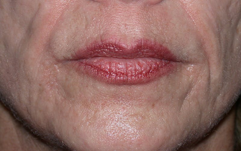 Laser Treatments Before & After Gallery - Patient 833857 - Image 1