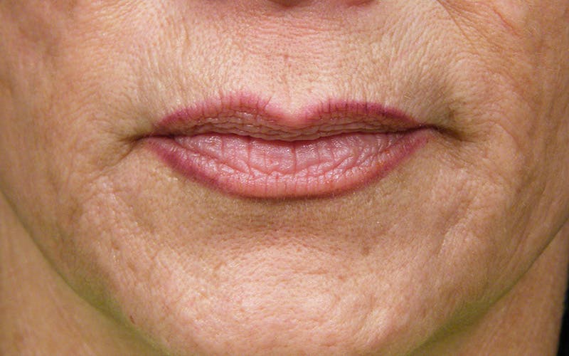 Laser Treatments Before & After Gallery - Patient 833857 - Image 2