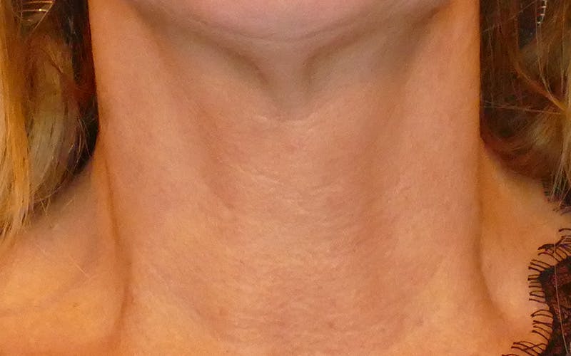 Laser Treatments Before & After Gallery - Patient 234290 - Image 8