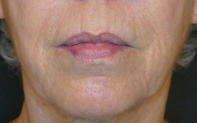 Laser Treatments Before & After Gallery - Patient 189107 - Image 2