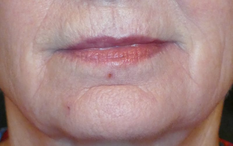 Laser Treatments Before & After Gallery - Patient 431074 - Image 1