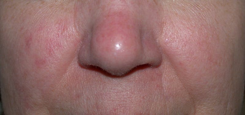 Photorejuvenation Before & After Gallery - Patient 266788 - Image 1