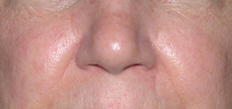 Photorejuvenation Before & After Gallery - Patient 266788 - Image 2