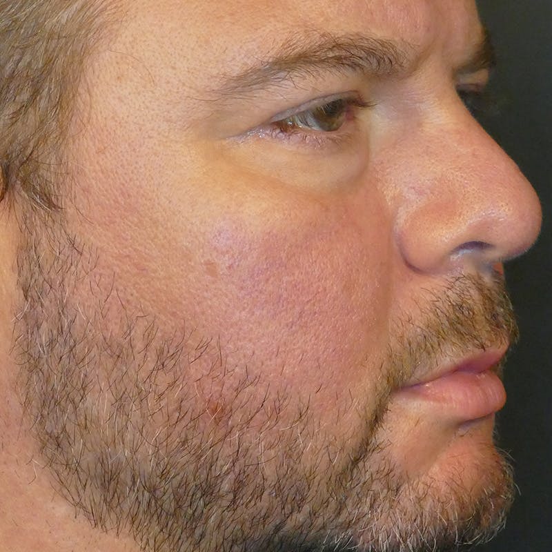 Photorejuvenation Before & After Gallery - Patient 414818 - Image 1