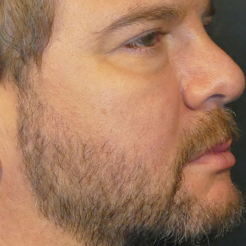 Photorejuvenation Before & After Gallery - Patient 414818 - Image 2