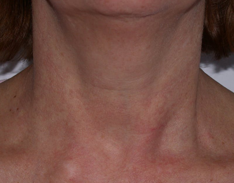Photorejuvenation Before & After Gallery - Patient 430820 - Image 1