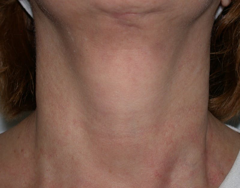 Photorejuvenation Before & After Gallery - Patient 430820 - Image 2
