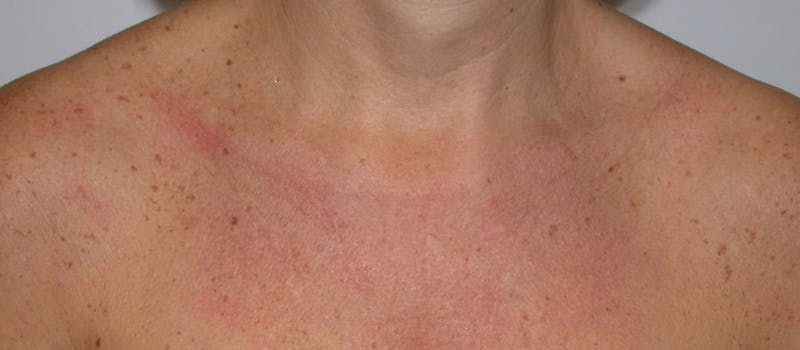 Photorejuvenation Before & After Gallery - Patient 356582 - Image 1
