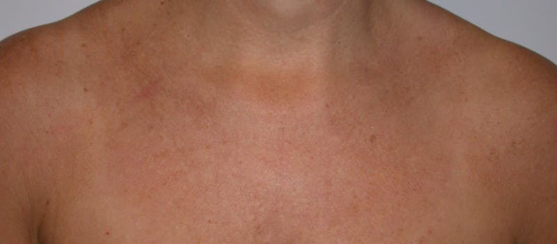 Photorejuvenation Before & After Gallery - Patient 356582 - Image 2