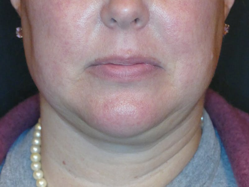 Kybella Before & After Gallery - Patient 687384 - Image 3
