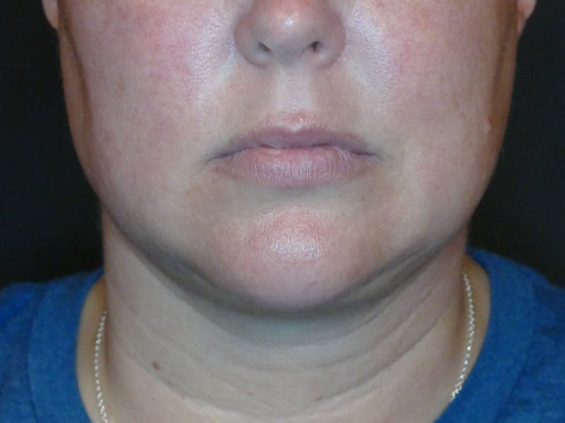 Kybella Before & After Gallery - Patient 687384 - Image 4