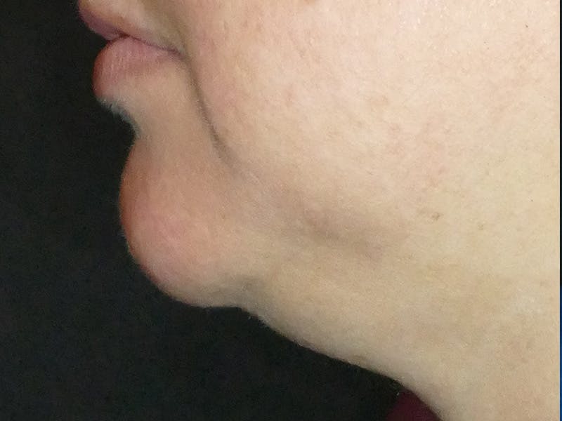 Kybella Before & After Gallery - Patient 687384 - Image 1