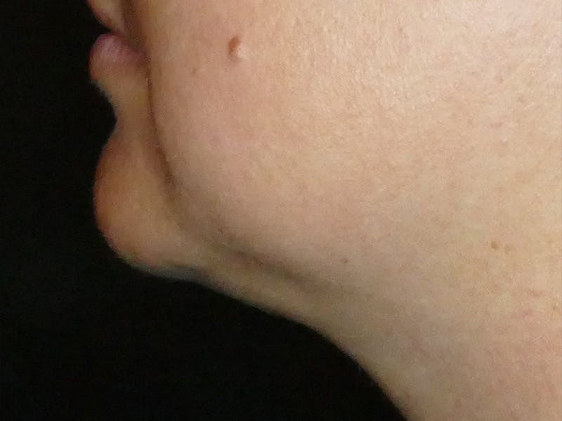 Kybella Before & After Gallery - Patient 687384 - Image 2