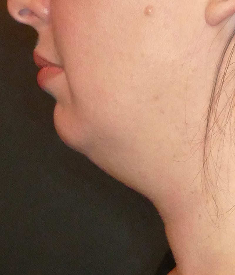 Kybella Before & After Gallery - Patient 112066 - Image 1