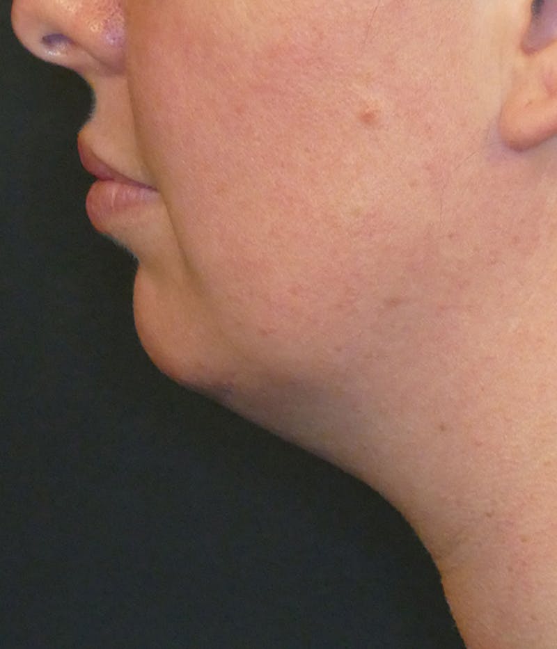 Kybella Before & After Gallery - Patient 112066 - Image 2