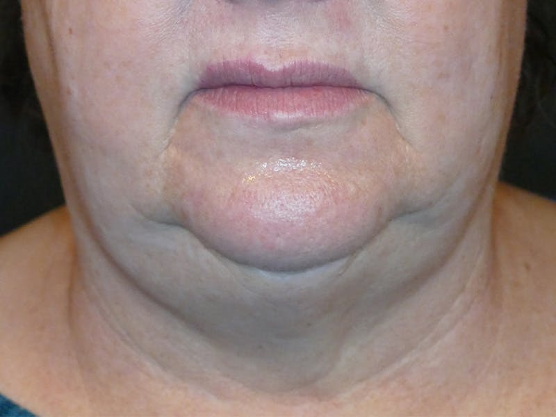 Kybella Before & After Gallery - Patient 360237 - Image 1